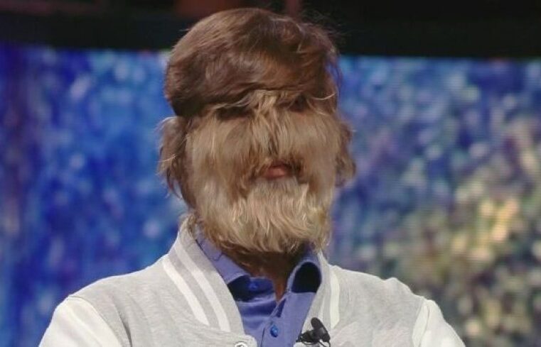 Homem com síndrome do lobisomem vira fenômeno na internet