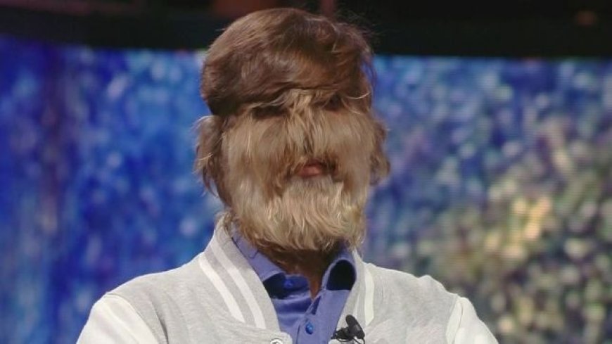 Homem com síndrome do lobisomem vira fenômeno na internet